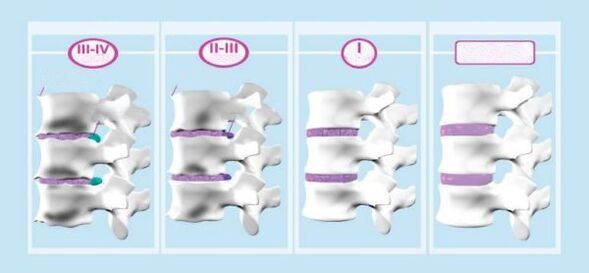 Etapas da osteocondrose cervical
