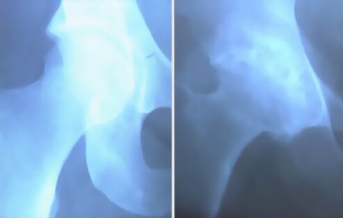 Scum de artrose da articulación do xeonllo