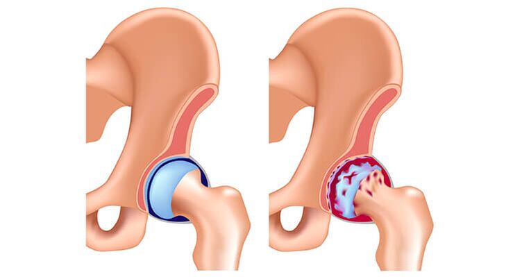 articulación da cadeira sa e afectada por artrose