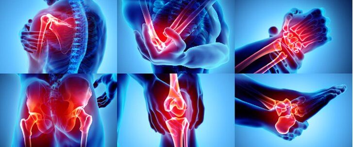 Articulacións inflamadas